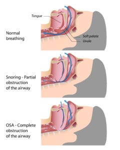 Diagram of Normal breathing Partial Obstruction and OSA as posted on Snoring blog article by Simply Good Sleep